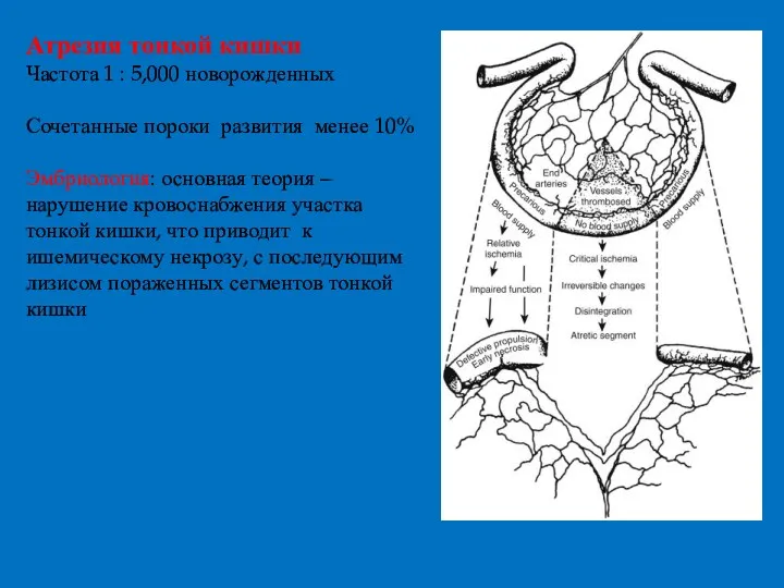 Атрезия тонкой кишки Частота 1 : 5,000 новорожденных Сочетанные пороки