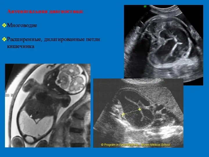 Антенатальная диагностика: Многоводие Расширенные, дилатированные петли кишечника