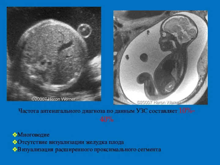 Частота антенатального диагноза по данным УЗС составляет 10%- 40% Многоводие