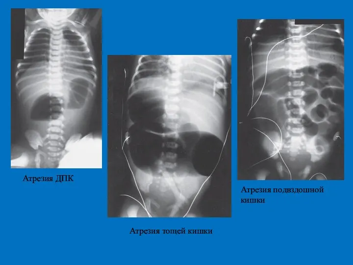 Атрезия ДПК Атрезия тощей кишки Атрезия подвздошной кишки