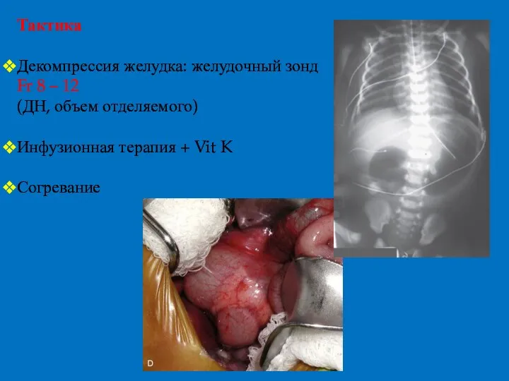 Тактика Декомпрессия желудка: желудочный зонд Fr 8 – 12 (ДН,