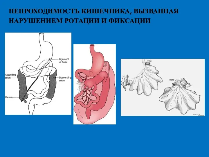 НЕПРОХОДИМОСТЬ КИШЕЧНИКА, ВЫЗВАННАЯ НАРУШЕНИЕМ РОТАЦИИ И ФИКСАЦИИ