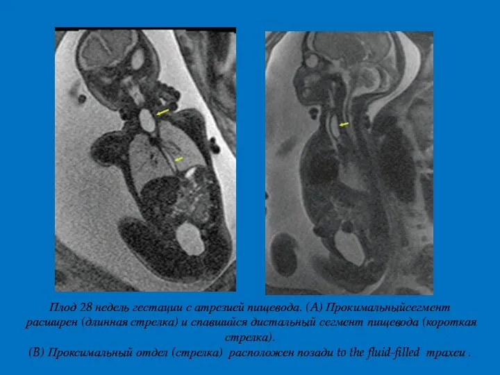 Плод 28 недель гестации с атрезией пищевода. (A) Прокимальныйсегмент расширен
