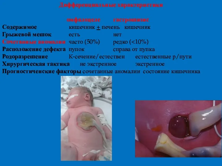 Дифференциальные характеристики омфалоцеле гастрошизис Содержимое кишечник + печень кишечник Грыжевой