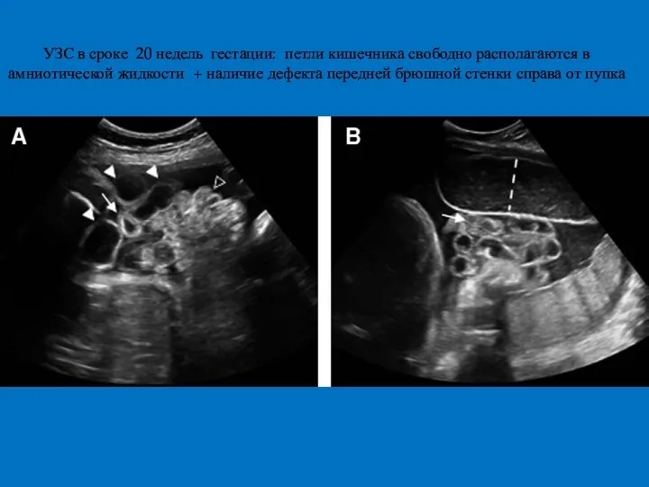 УЗС в сроке 20 недель гестации: петли кишечника свободно располагаются