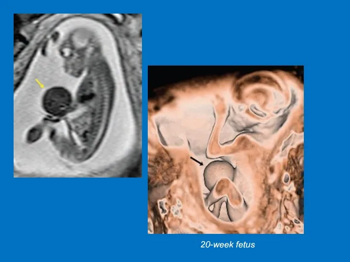 20-week fetus