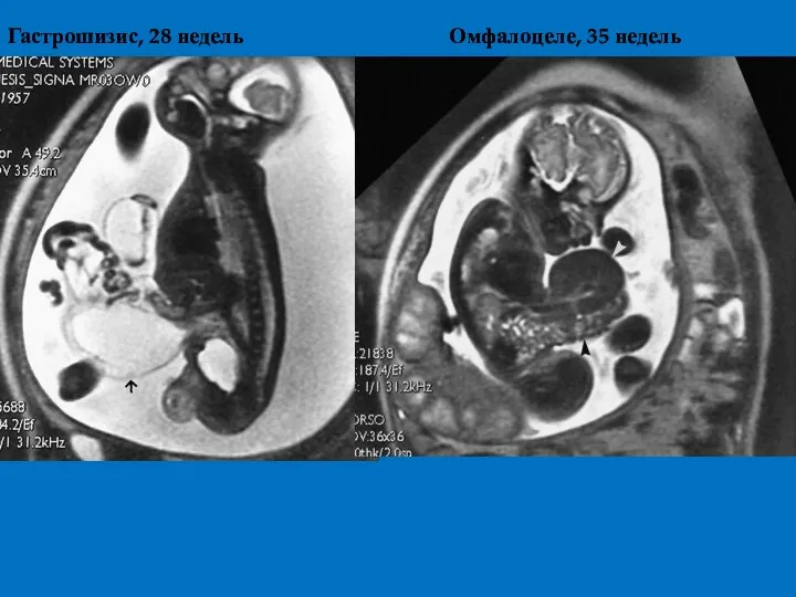Гастрошизис, 28 недель Омфалоцеле, 35 недель