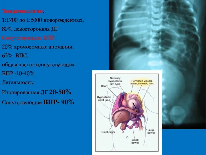 Эпидемиология. 1:1700 до 1:5000 новорожденных. 80% левосторонняя ДГ Сопутствующие ВПР: