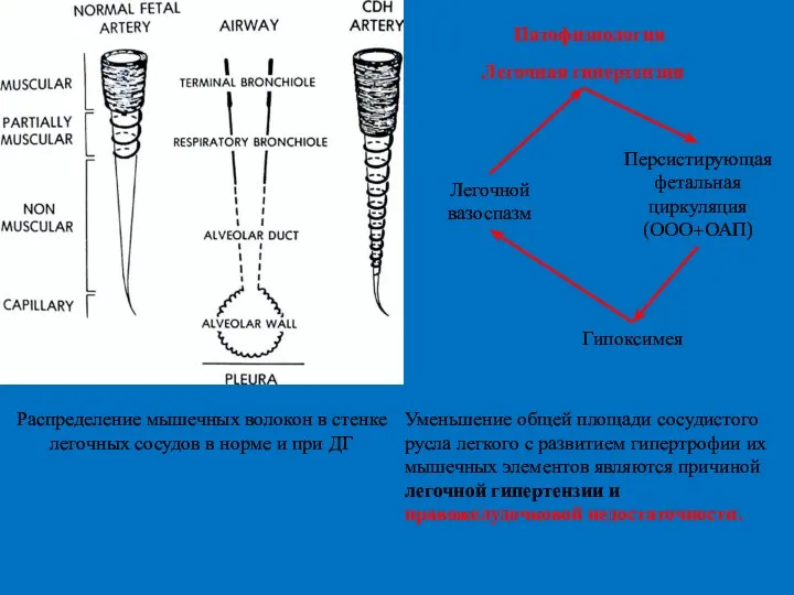Распределение мышечных волокон в стенке легочных сосудов в норме и