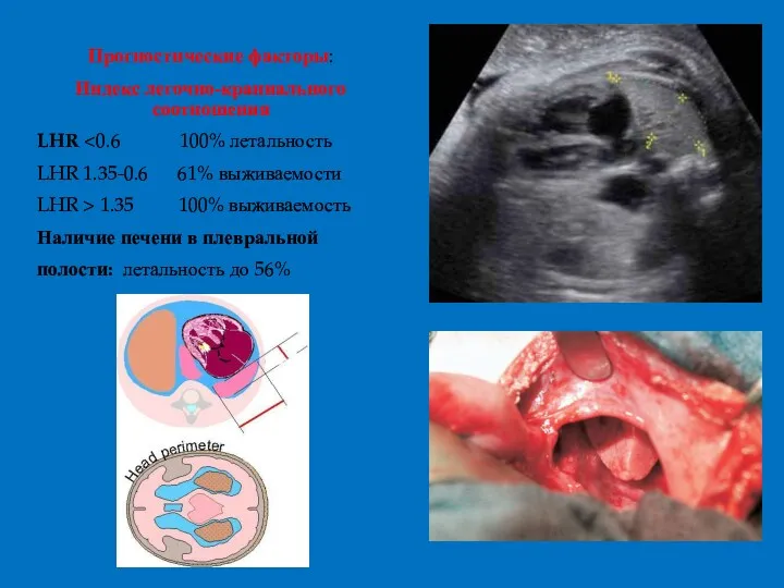 Прогностические факторы: Индекс легочно-краниального соотношения LHR LHR 1.35-0.6 61% выживаемости