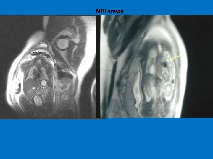 MRI плода