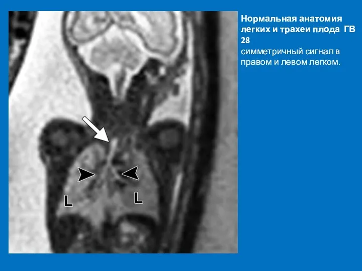 Нормальная анатомия легких и трахеи плода ГВ 28 симметричный сигнал в правом и левом легком.