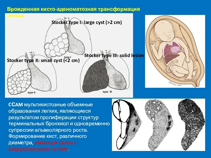 Врожденная кисто-аденоматозная трансформация легких CСAM мультикистозные объемные образования легких, являющиеся