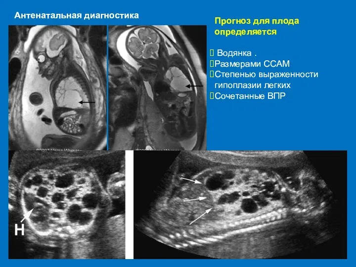 Прогноз для плода определяется Водянка . Размерами ССАМ Степенью выраженности гипоплазии легких Сочетанные ВПР Антенатальная диагностика