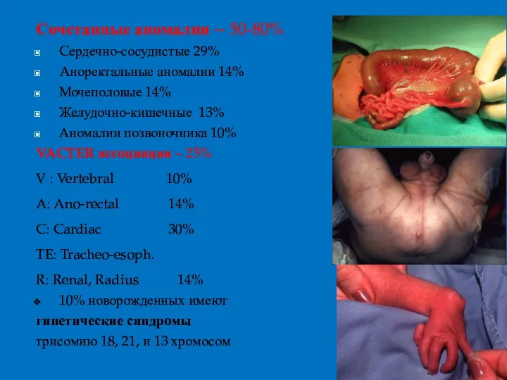 Сочетанные аномалии -- 50-80% Cердечно-сосудистые 29% Aноректальные аномалии 14% Мочеполовые