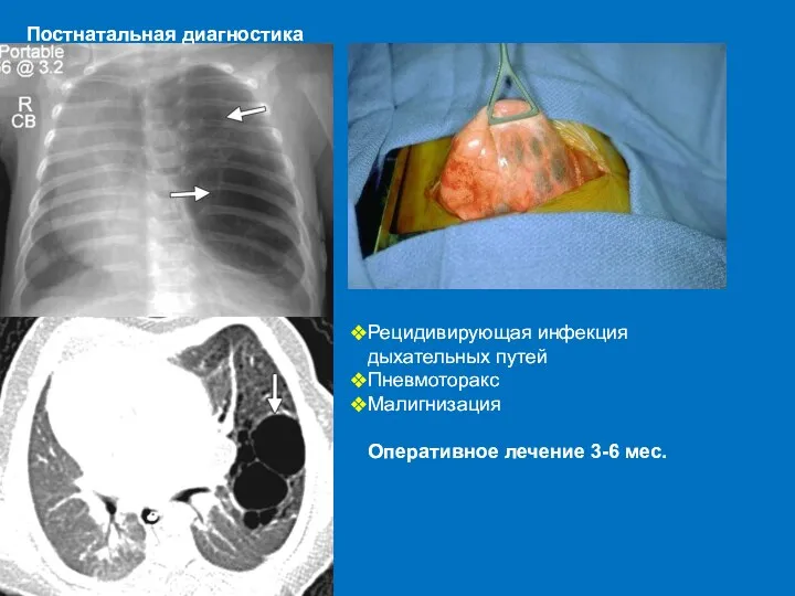 Постнатальная диагностика Рецидивирующая инфекция дыхательных путей Пневмоторакс Малигнизация Оперативное лечение 3-6 мес.