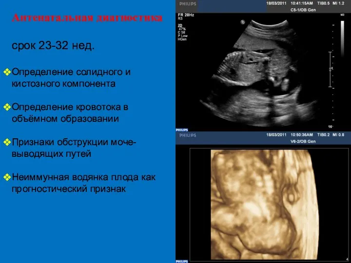 Антенатальная диагностика срок 23-32 нед. Определение солидного и кистозного компонента