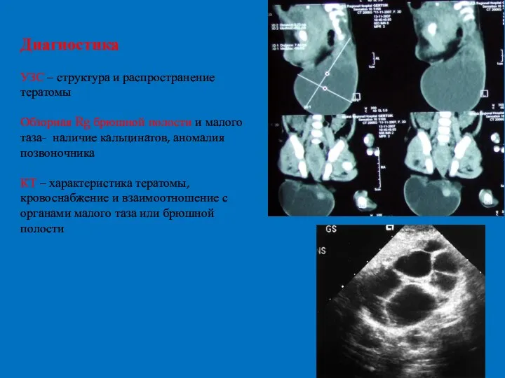 Диагностика УЗС – структура и распространение тератомы Обзорная Rg брюшной