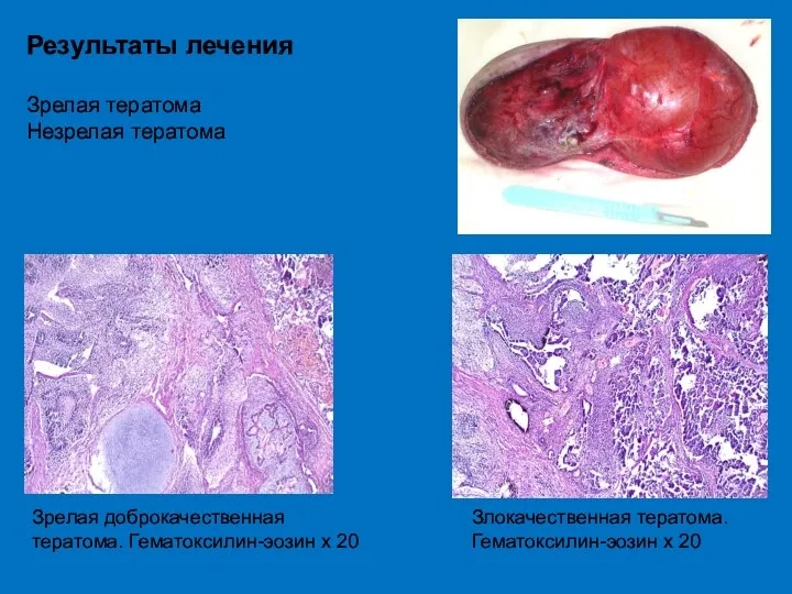 Результаты лечения Зрелая тератома Незрелая тератома Зрелая доброкачественная тератома. Гематоксилин-эозин