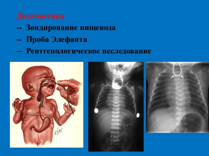 Диагностика -- Зондирование пищевода -- Проба Элефанта -- Рентгенологическое исследование