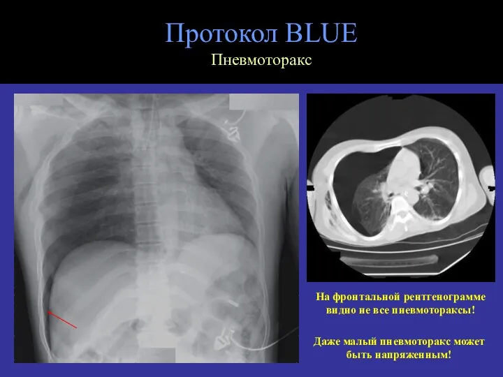 Протокол BLUE Пневмоторакс На фронтальной рентгенограмме видно не все пневмотораксы! Даже малый пневмоторакс может быть напряженным!