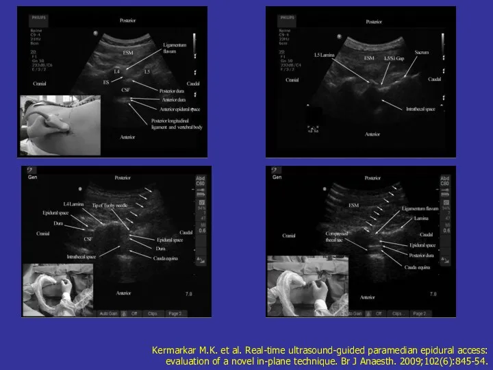 Kermarkar M.K. et al. Real-time ultrasound-guided paramedian epidural access: evaluation of a novel