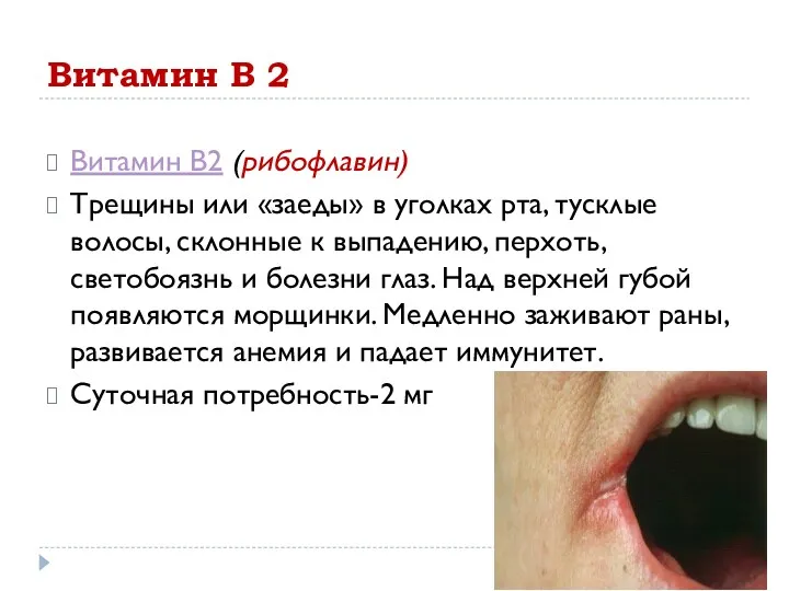 Витамин В 2 Витамин В2 (рибофлавин) Трещины или «заеды» в уголках рта, тусклые