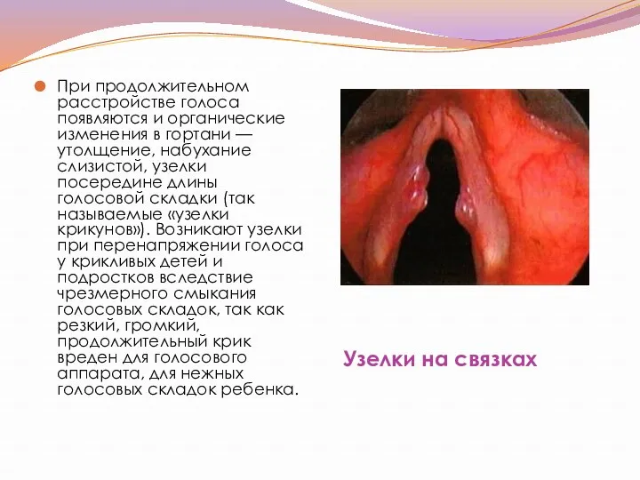 Узелки на связках При продолжительном расстройстве голоса появляются и органические