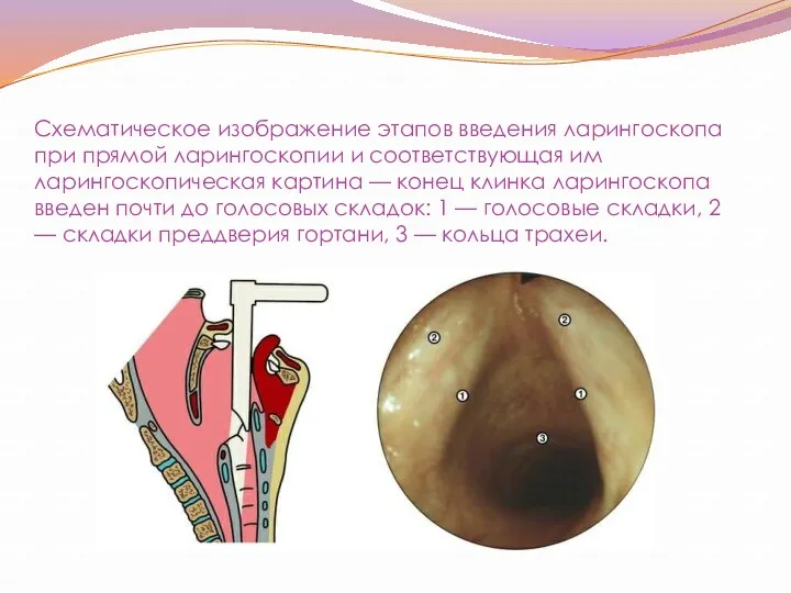 Схематическое изображение этапов введения ларингоскопа при прямой ларингоскопии и соответствующая