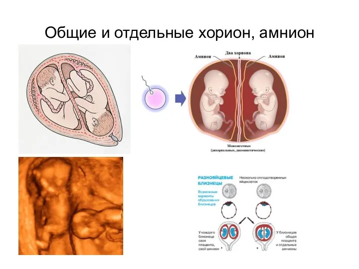 Общие и отдельные хорион, амнион