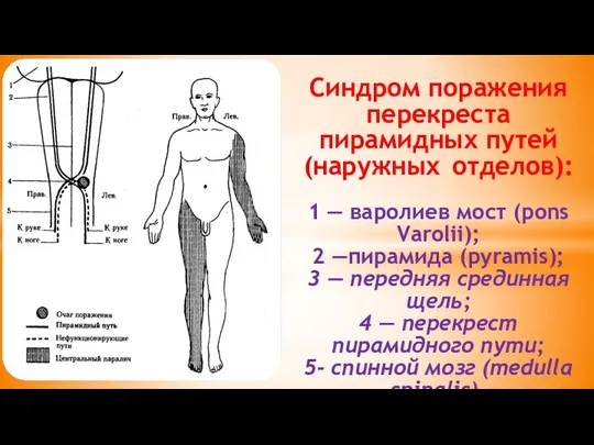 Синдром поражения перекреста пирамидных путей (наружных отделов): 1 — варолиев