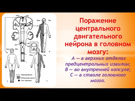 Поражение центрального двигательного нейрона в головном мозгу: А — в