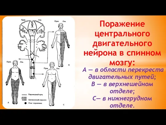 Поражение центрального двигательного нейрона в спинном мозгу: А — в