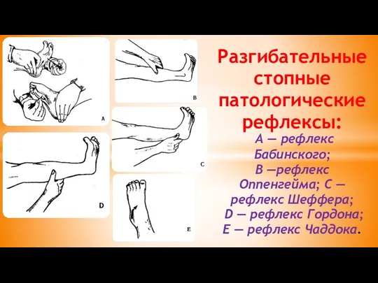 Разгибательные стопные патологические рефлексы: А — рефлекс Бабинского; В —рефлекс