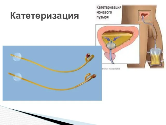 Катетеризация