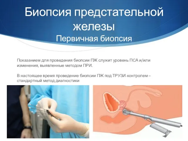 Биопсия предстательной железы Первичная биопсия Показанием для проведения биопсии ПЖ