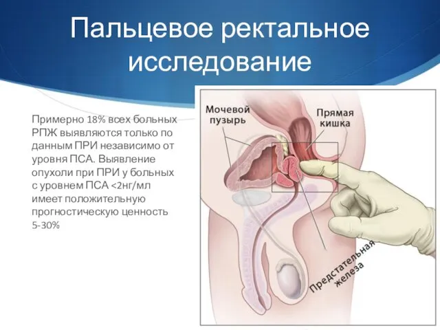 Пальцевое ректальное исследование Примерно 18% всех больных РПЖ выявляются только