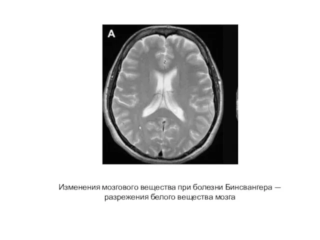 Изменения мозгового вещества при болезни Бинсвангера — разрежения белого вещества мозга