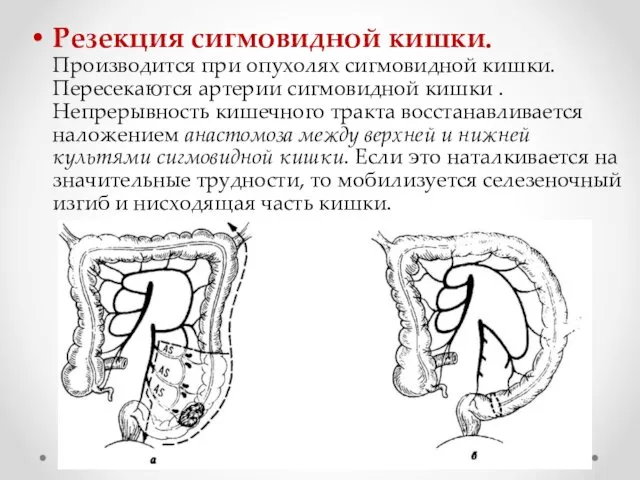 Резекция сигмовидной кишки. Производится при опухолях сигмовидной кишки. Пересекаются артерии сигмовидной кишки .