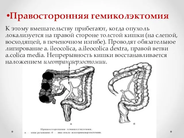 Правосторонняя гемиколэктомия К этому вмешательству прибегают, когда опухоль локализуется на правой стороне толстой