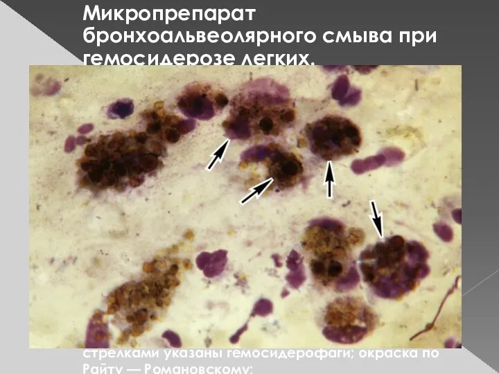 Микропрепарат бронхоальвеолярного смыва при гемосидерозе легких. стрелками указаны гемосидерофаги; окраска по Райту — Романовскому;