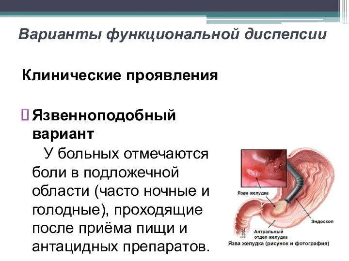 Варианты функциональной диспепсии Клинические проявления Язвенноподобный вариант У больных отмечаются боли в подложечной