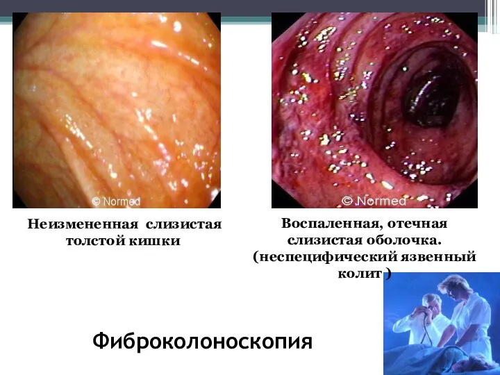 Фиброколоноскопия Воспаленная, отечная слизистая оболочка. (неспецифический язвенный колит ) Неизмененная слизистая толстой кишки
