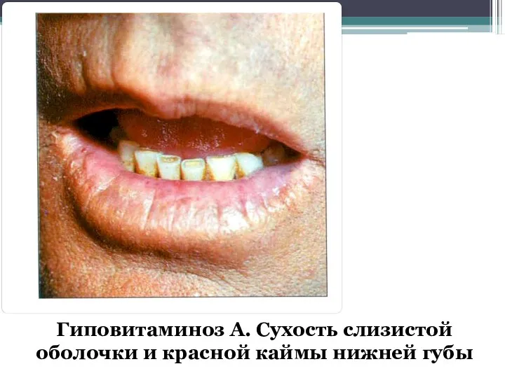 Гиповитаминоз А. Сухость слизистой оболочки и красной каймы нижней губы