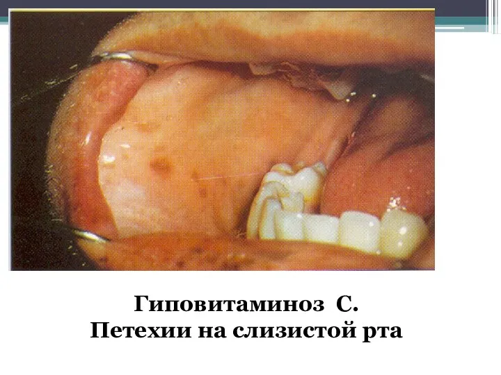 Гиповитаминоз С. Петехии на слизистой рта