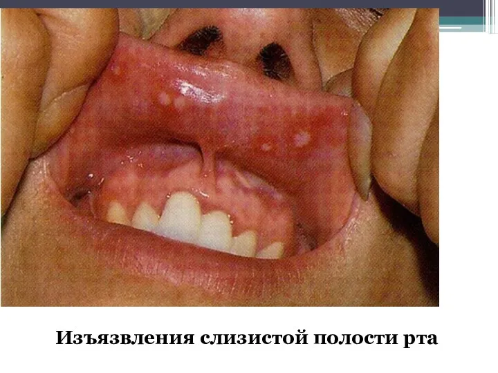 Изъязвления слизистой полости рта