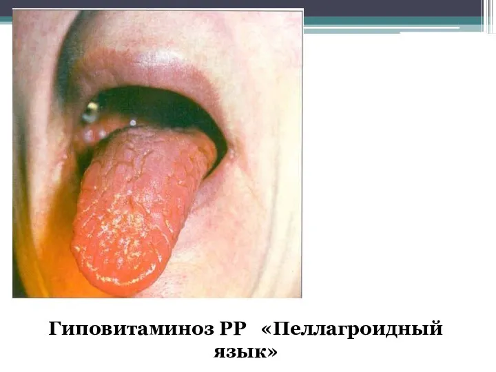 Гиповитаминоз РР «Пеллагроидный язык»
