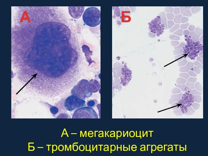 А – мегакариоцит Б – тромбоцитарные агрегаты А Б