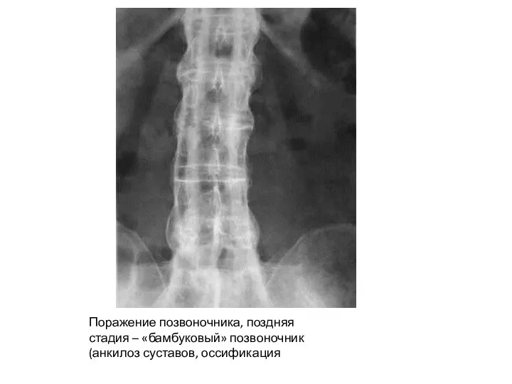 Поражение позвоночника, поздняя стадия – «бамбуковый» позвоночник (анкилоз суставов, оссификация