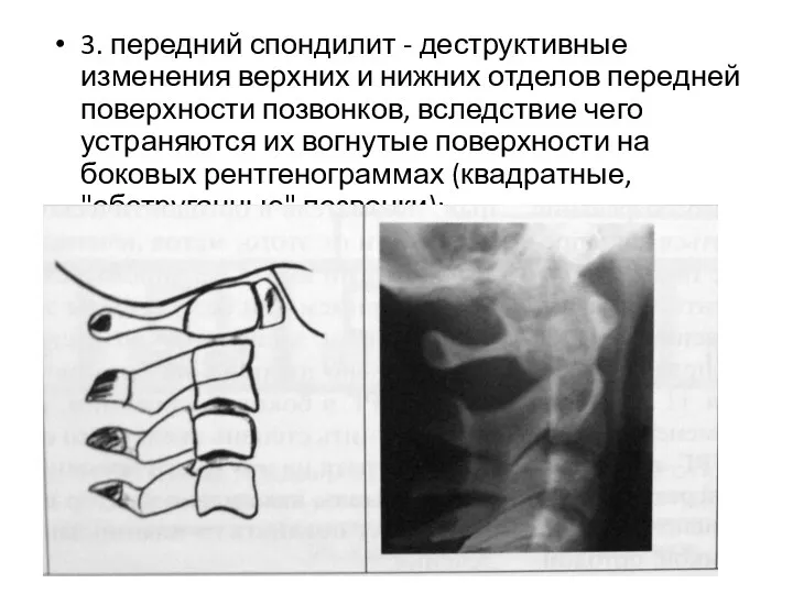 3. передний спондилит - деструктивные изменения верхних и нижних отделов